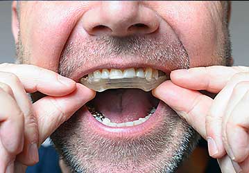 Welcome Smile Dental | Bruxism Teeth Grinding Appliance Calgary