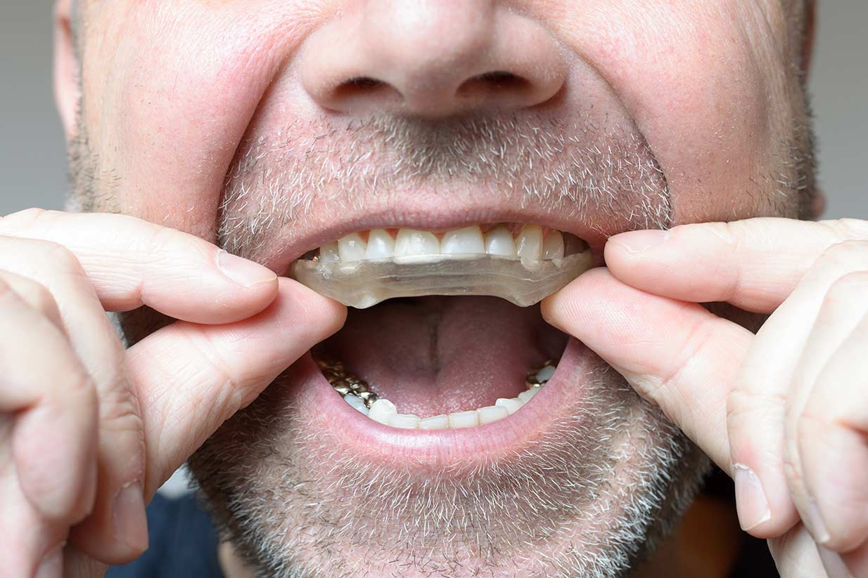 Bruxism Teeth Grinding | Welcome Smile Dental | Calgary Dentist