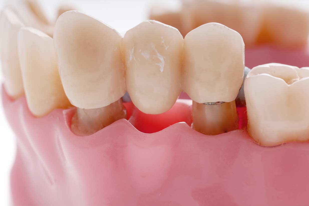 Calgary Dental Bridge | Welcome Smile Dental | Calgary Dentistry | Calgary AB