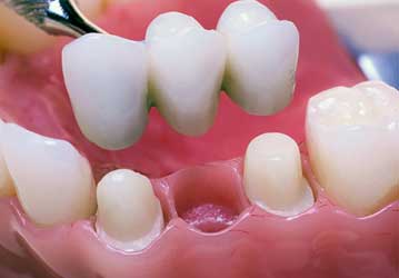 Welcome Smile Dental | Dental Bridges