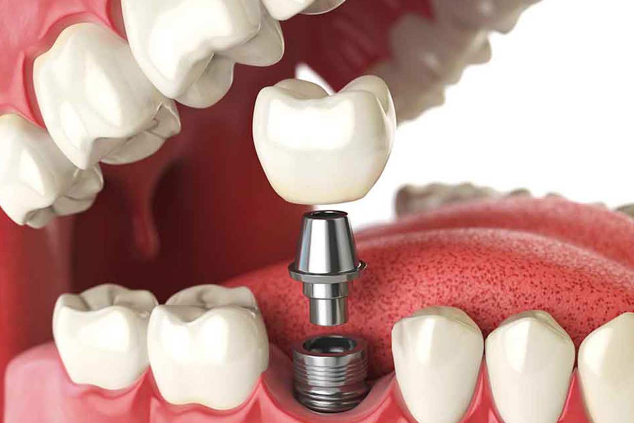 Dental Implants | Welcome Smile Dental | Calgary Dentist
