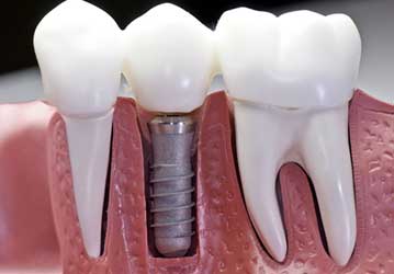 Welcome Smile Dental | Dental Implants