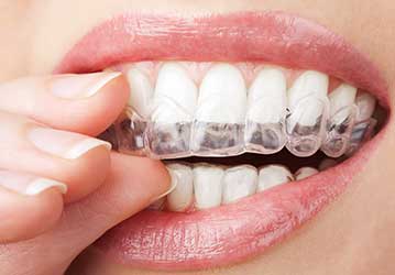 Calgary Invisalign Dentist