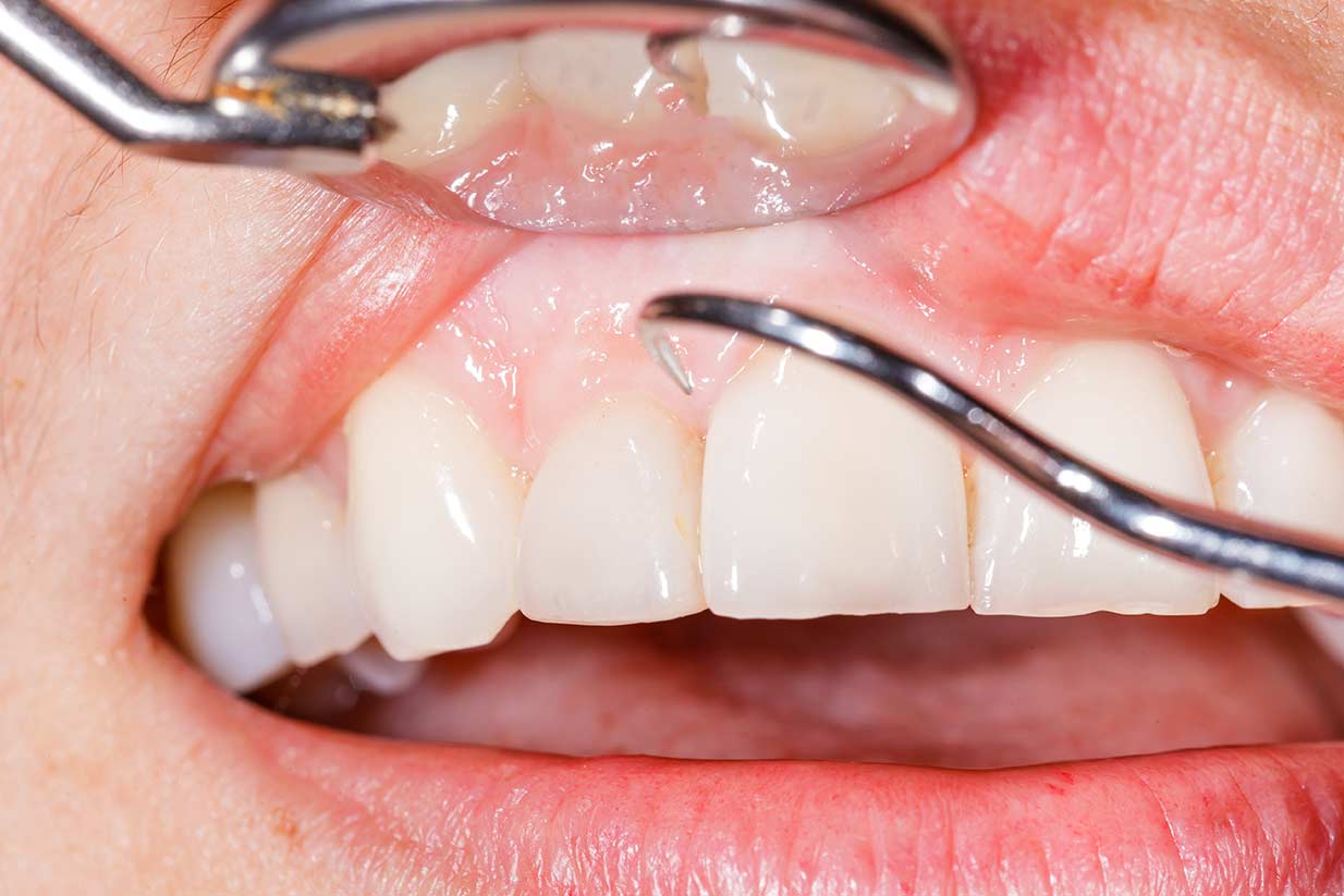 Periodontal Care | Welcome Smile Dental | Calgary Dentist