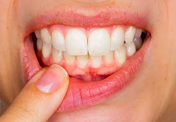 Welcome Smile Dental | Periodontitis Preventative Treatment