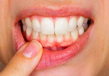Welcome Smile Dental | Periodontitis Preventative Treatment | Calgary Dentist | Calgary AB