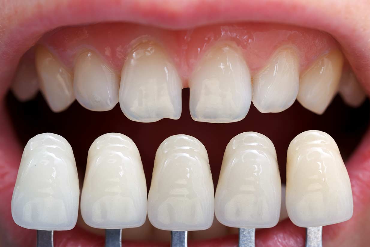 Calgary Porcelain Veneers | Welcome Smile Dental | Calgary Dentistry