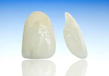 Calgary Porcelain Veneers | Welcome Smile Dental | Downtown Dentist | Calgary AB