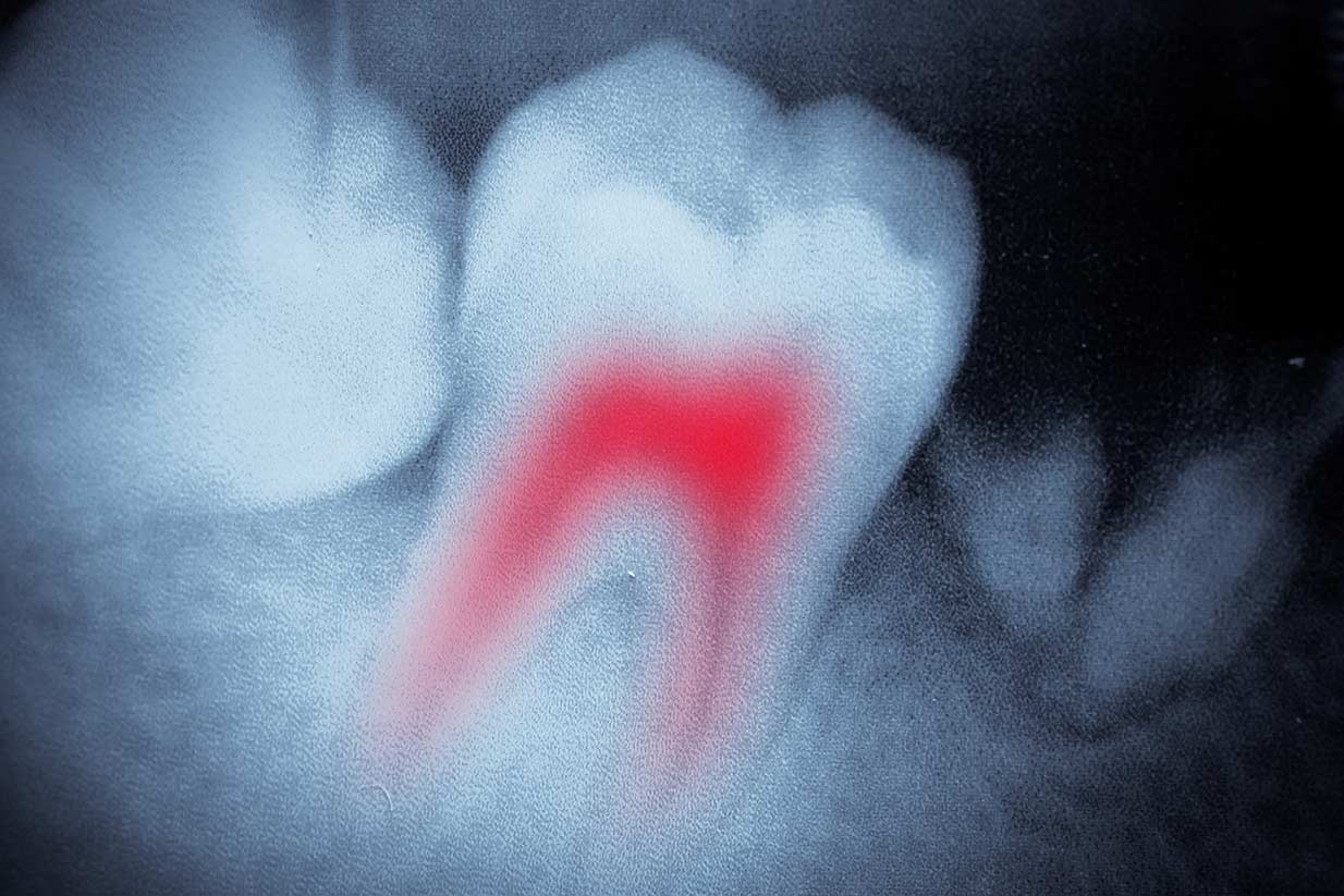 Calgary Root Canal Therapy | Welcome Smile Dental | Calgary Downtown Dentistry