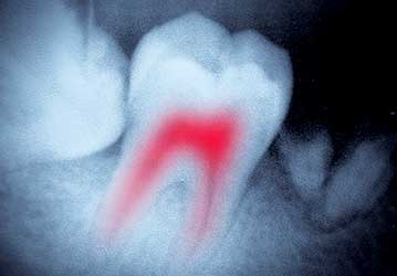 Welcome Smile Dental | Root Canal Therapy