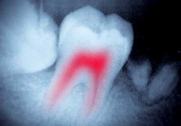 Welcome Smile Dental | Calgary Root Canal Therapy | Calgary Dentist | Calgary AB