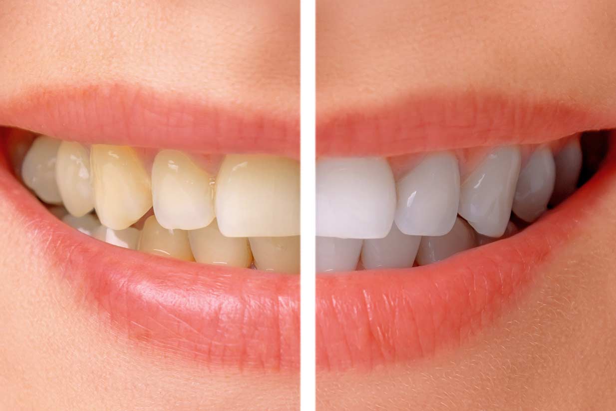 Teeth Whiteing | Welcome Smile Dental | Calgary Dentist