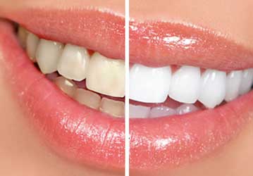 Welcome Smile Dental | Teeth Whitening